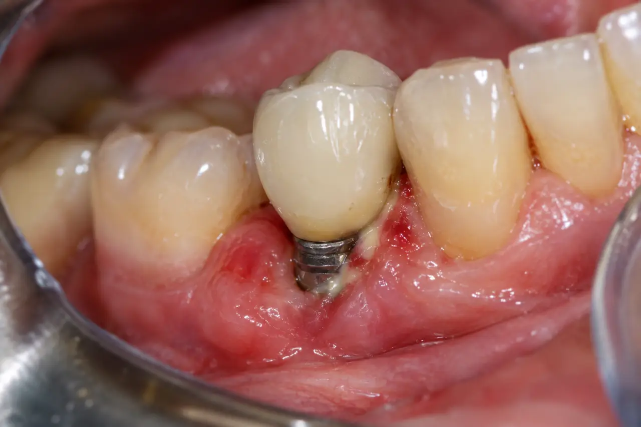 Infection d’un implant dentaire : pus, mobilité et perte osseuse, les signes à ne pas attendre