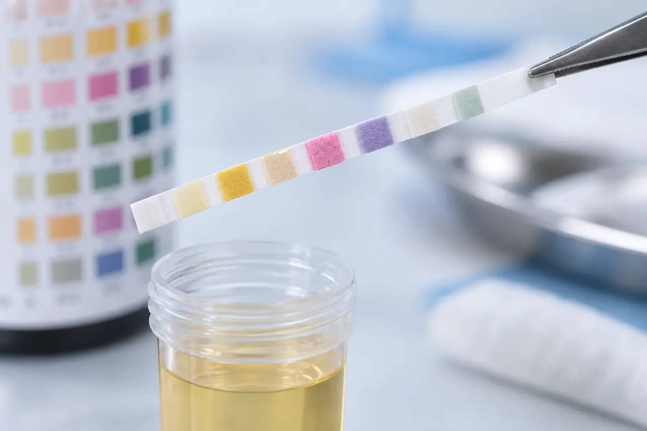 Bandelette positive, leucocytes ou nitrites : ce que révèle chaque résultat